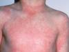SOMERSET NEWS: Scarlet fever on the increase in Somerset